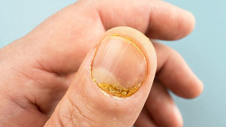 Toenail and Fingernail Deformities Are Common With Psoriatic Arthritis