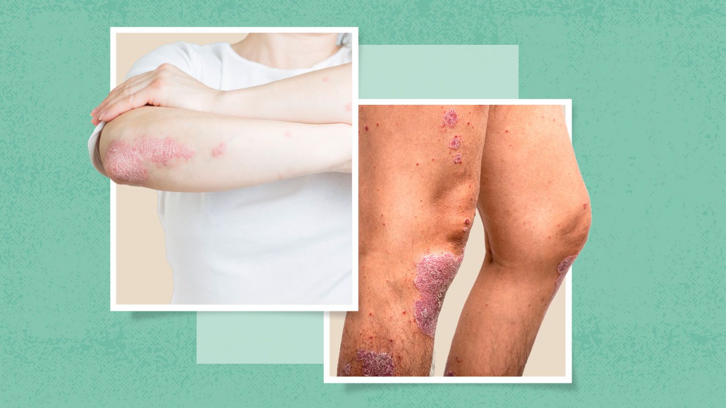 Knee and Elbow Psoriasis: How to Cope