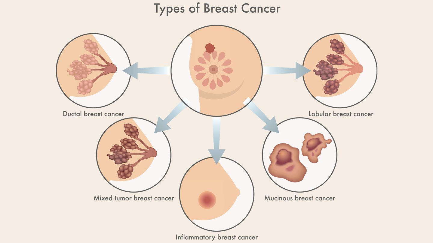 Breast Cancer Types