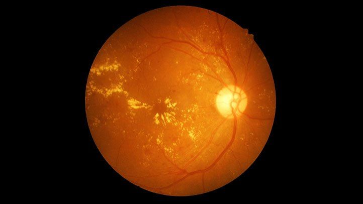 What Is Dry Macular Degeneration?