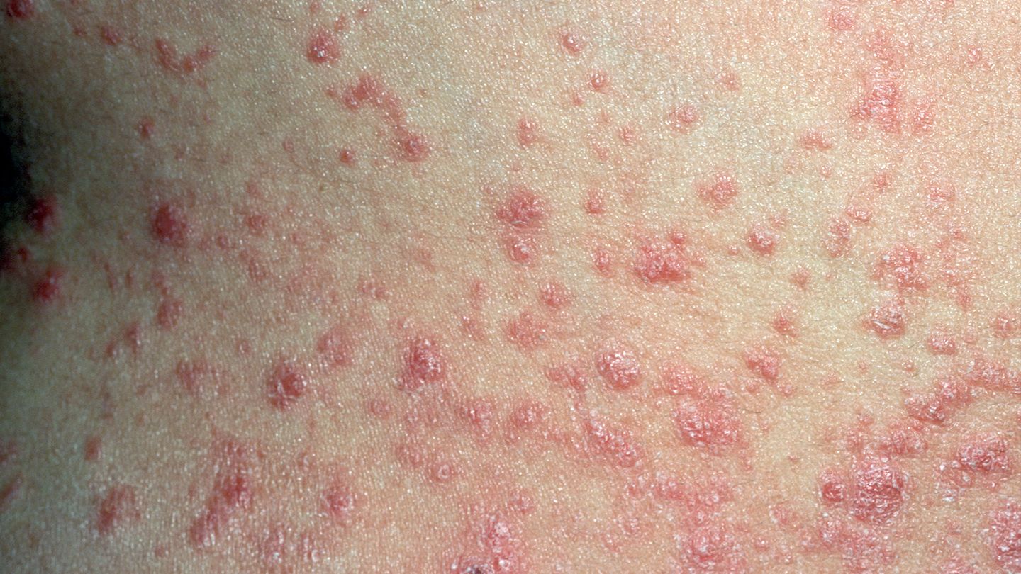Guttate Psoriasis: Causes, Symptoms, Treatments, and Complications