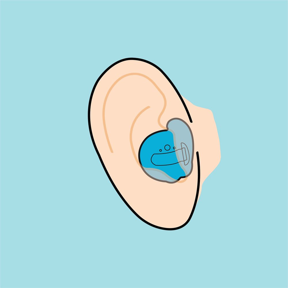 In-the-ear hearing aids fill the bowl of the ear and have no behind-the-ear element or tubing