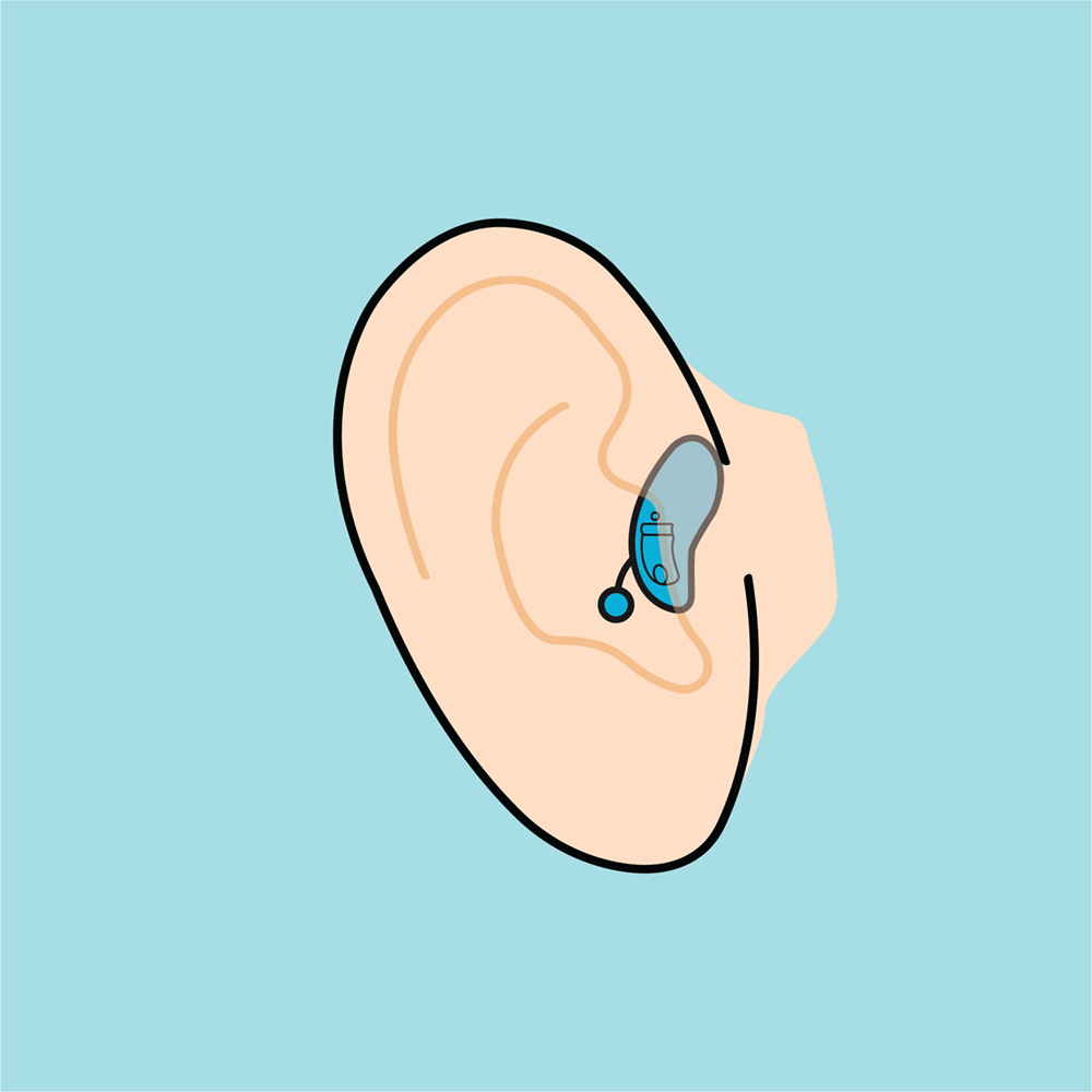 Completely-in-canal hearing aids sit just inside the ear canal