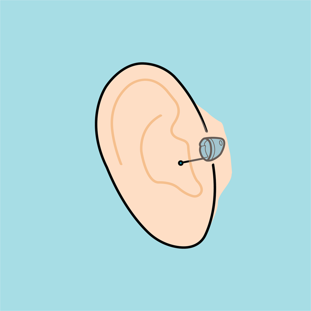 Invisible-in-canal hearing aids are embedded deep into the ear, with only a thin removal wire visible