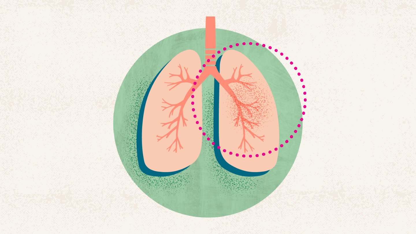 What Is Lung Cancer? Symptoms, Causes, Diagnosis, Treatment, and Prevention