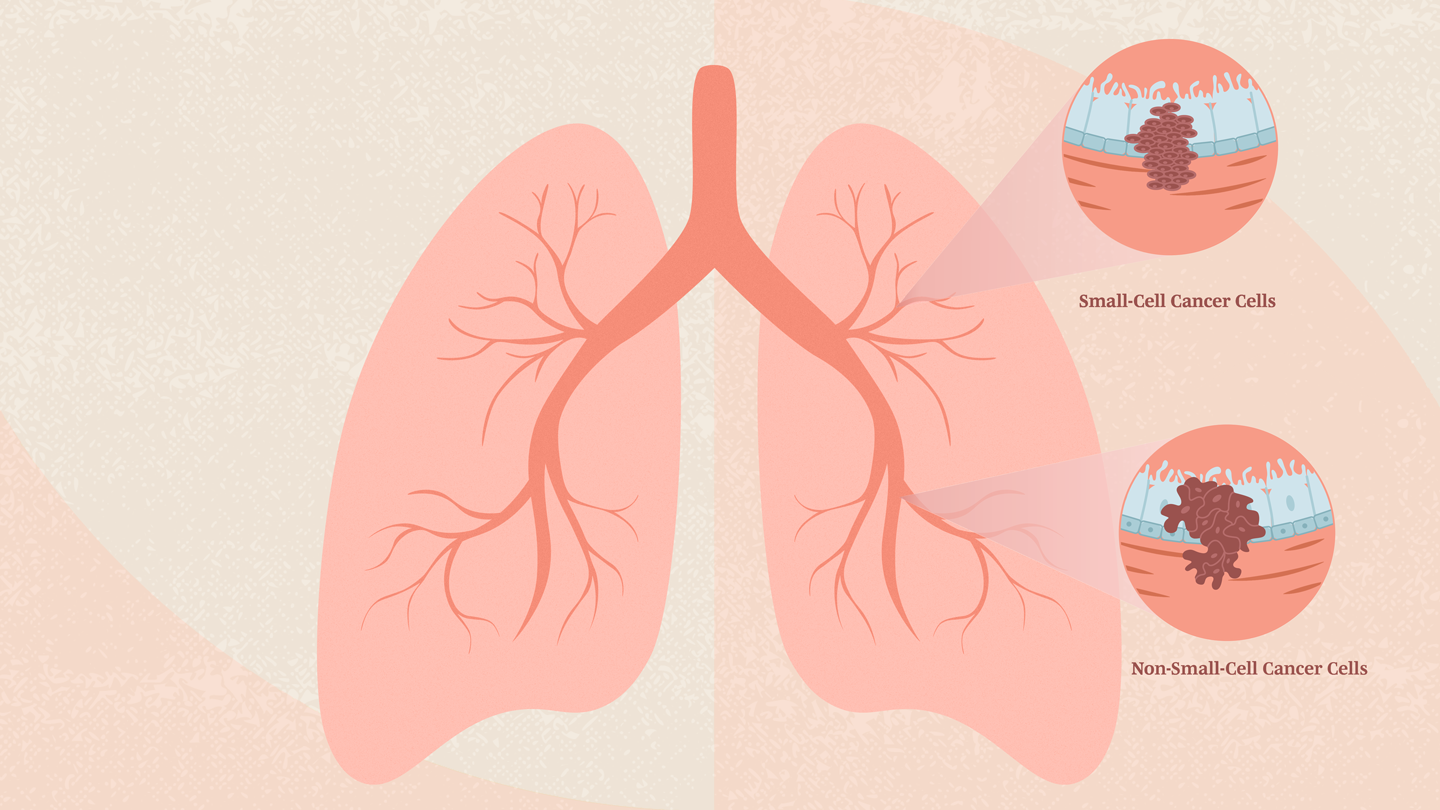 What Are the Different Types of Lung Cancer?