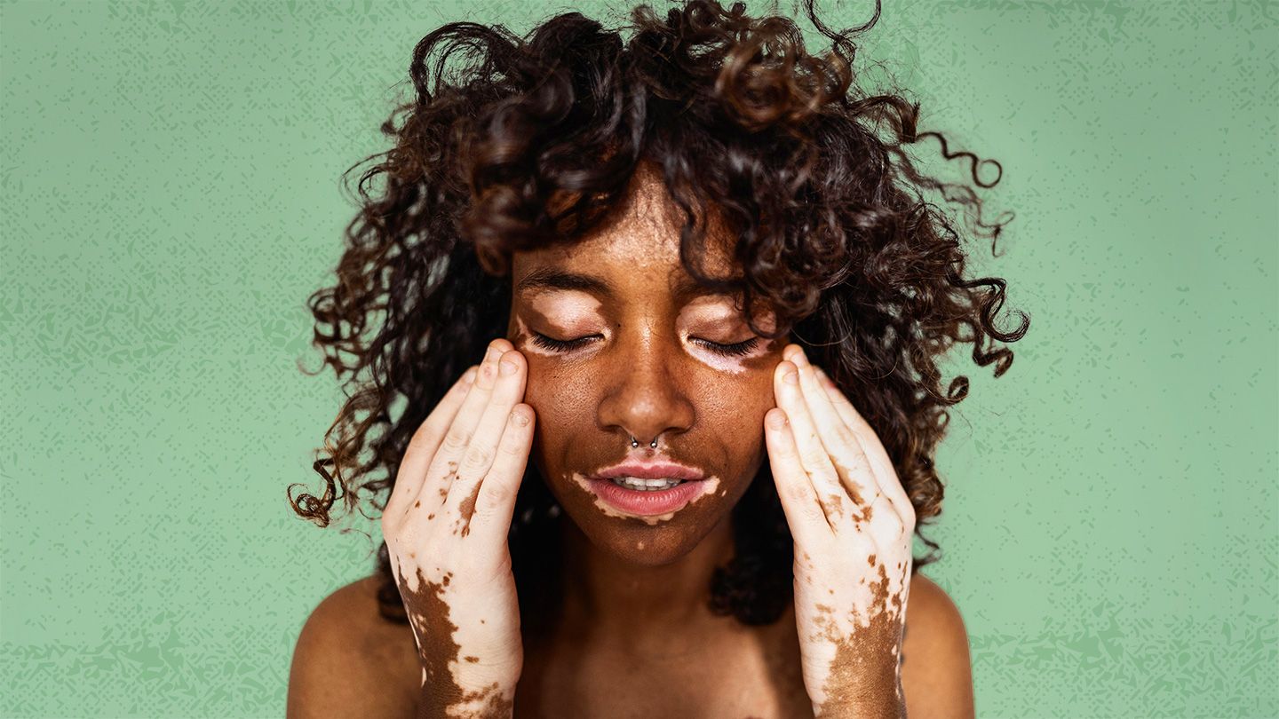 How Vitiligo Can Affect People of Color