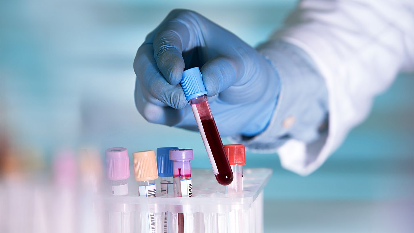 What Is a Liquid Biopsy for Lung Cancer — and Do You Need One?